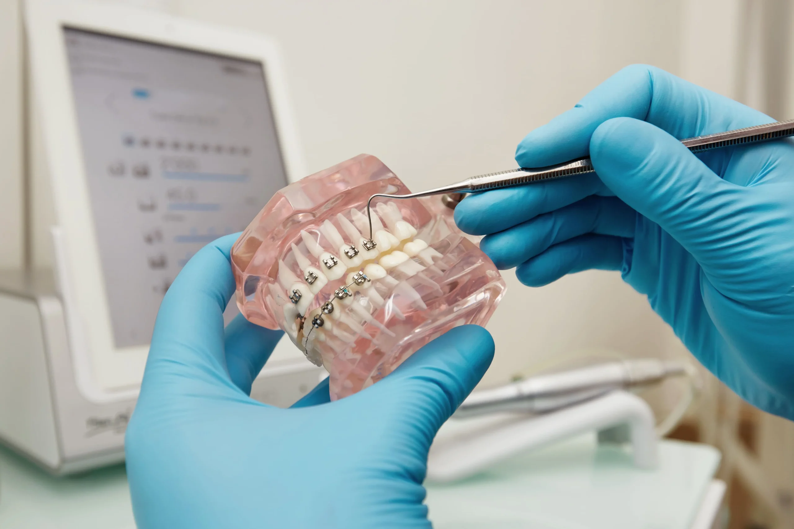 Comparativa Entre Ortodoncia De Brackets Y Ortodoncia Invisible En Huelva clinica dental laura vazquez
