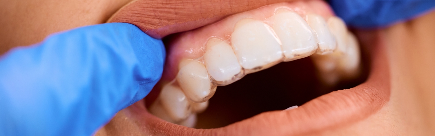 Ortodoncia brackets 3 - Clínica Dental Laura Vázquez