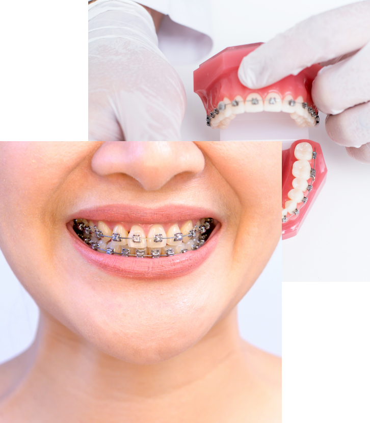 Ortodoncia brackets 1 - Clínica Dental Laura Vázquez