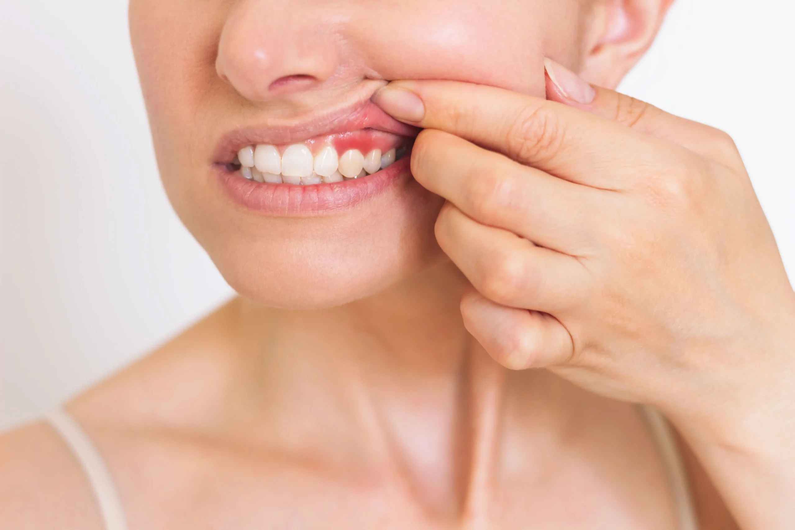 Enfermedad Periodontal periodoncia en corrales aljaraque huelva laura vazquez