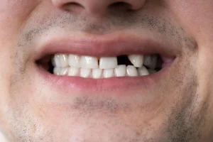 Pérdida dental implantes dentales en aljaraque corrales