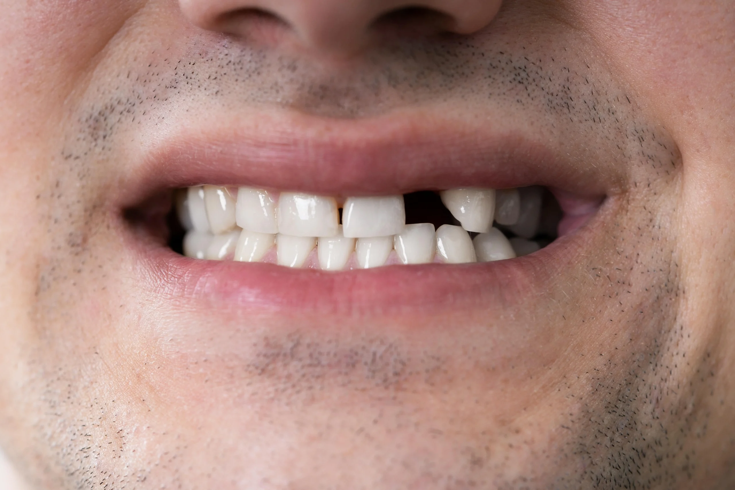 Pérdida dental implantes dentales en aljaraque corrales