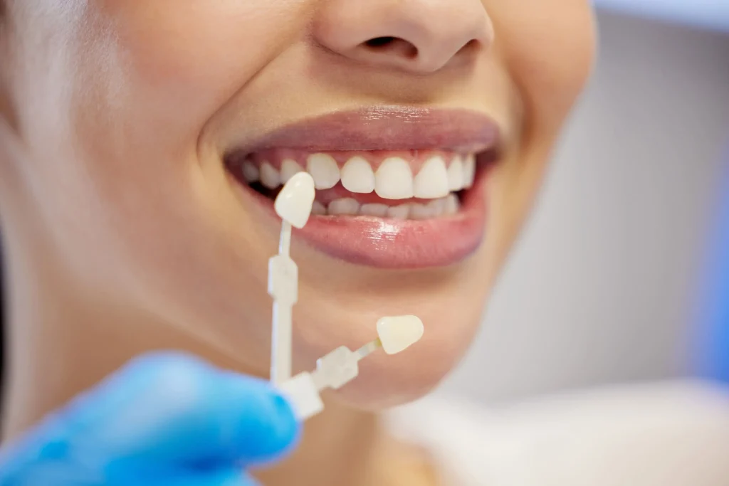 Carillas o blanqueamiento dental Cómo elegir la mejor opción estetca dental en huelva laura vazquez
