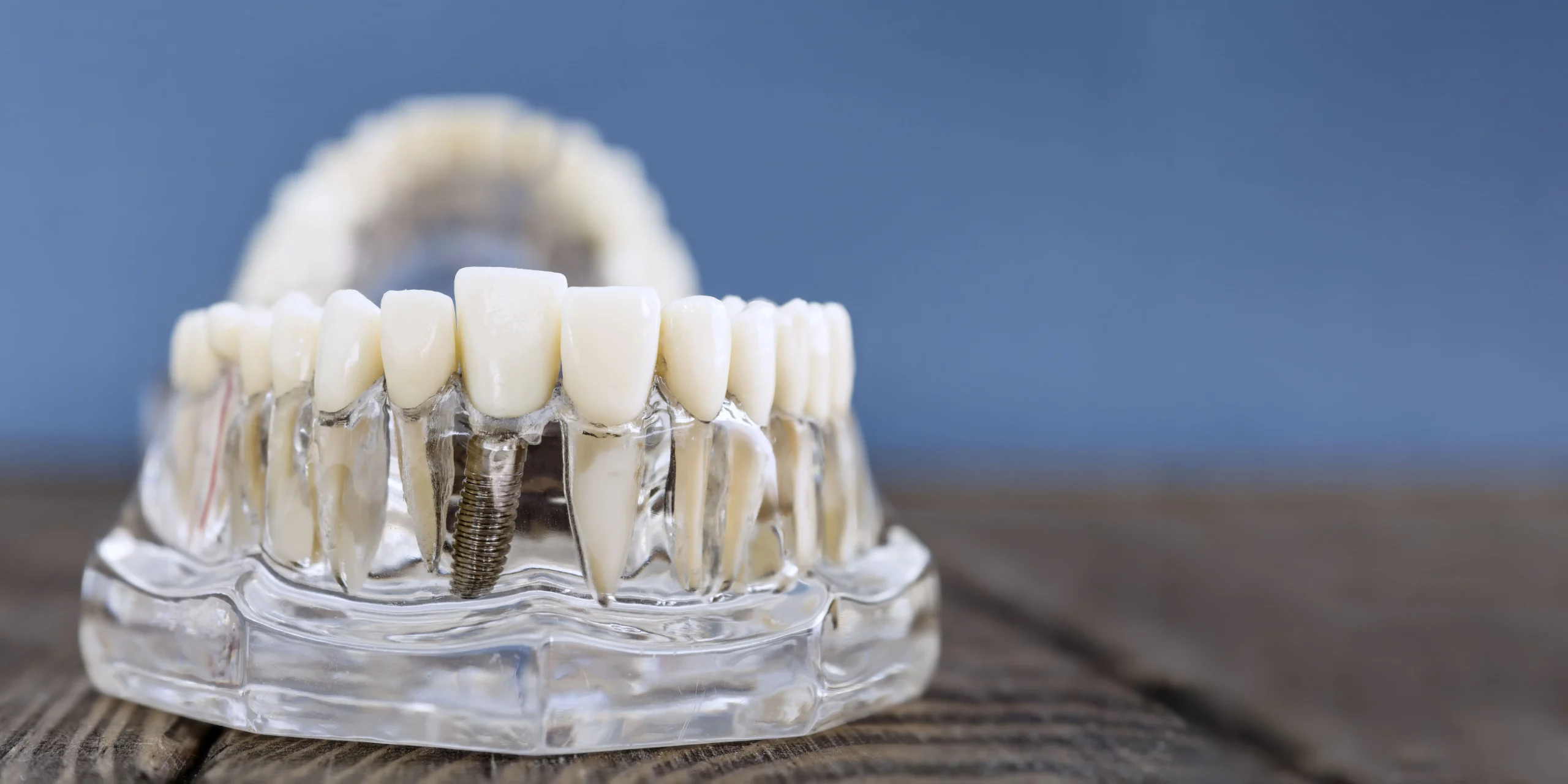 Implantes dentales cerca de Bellavista y La Monacilla qué debes saber implante dental en aljaraque corrales laura vazquez